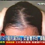 5個月減35kg！女營養不均　掉髮險禿